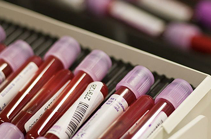 New blood test may assist in helping to determine who might respond to antidepressant medication